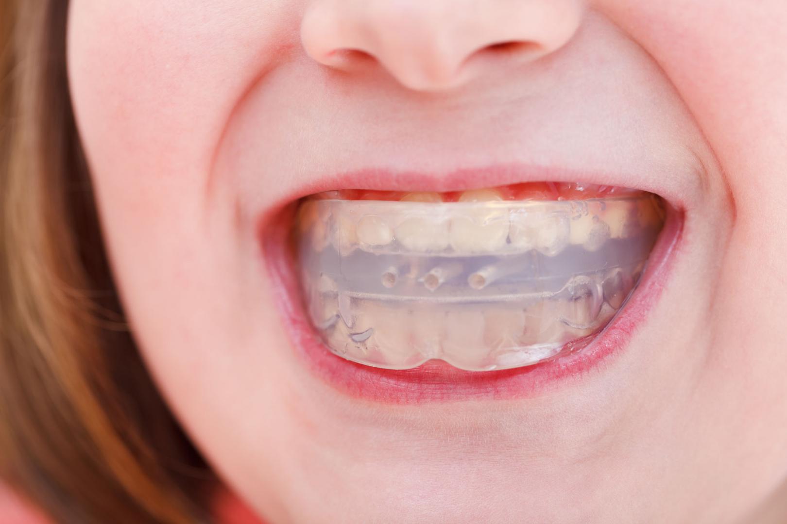 Sport mouthgard Ottawa Gatineau Nepean